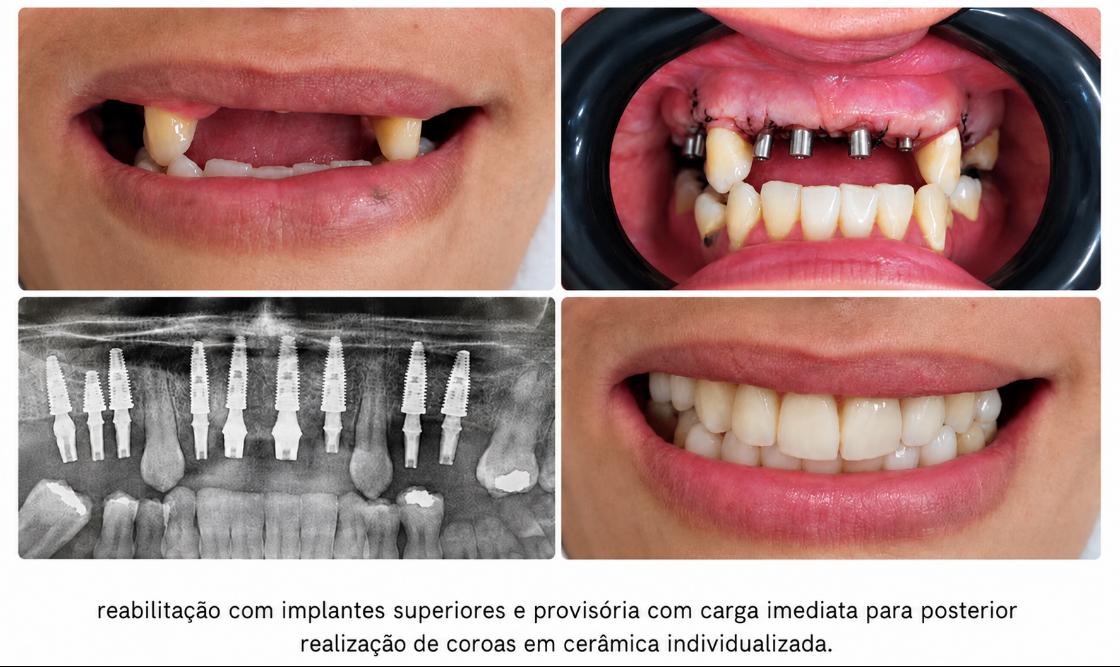 Reabilitação com implantes superiores e prótese provisória com carga imediata, seguida de coroas em cerâmica individualizada.