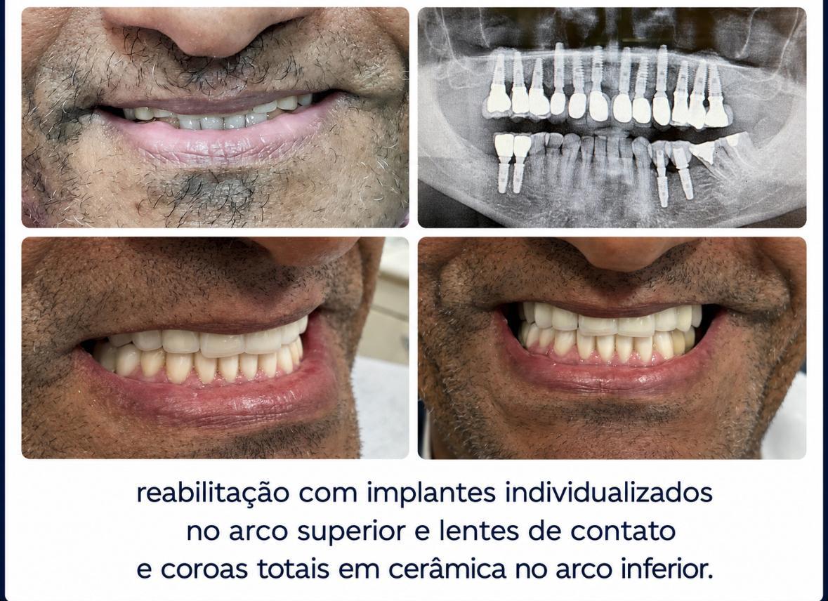Reabilitação com implantes individualizados no arco superior e lentes de contato e coroas totais em cerâmica no arco inferior.