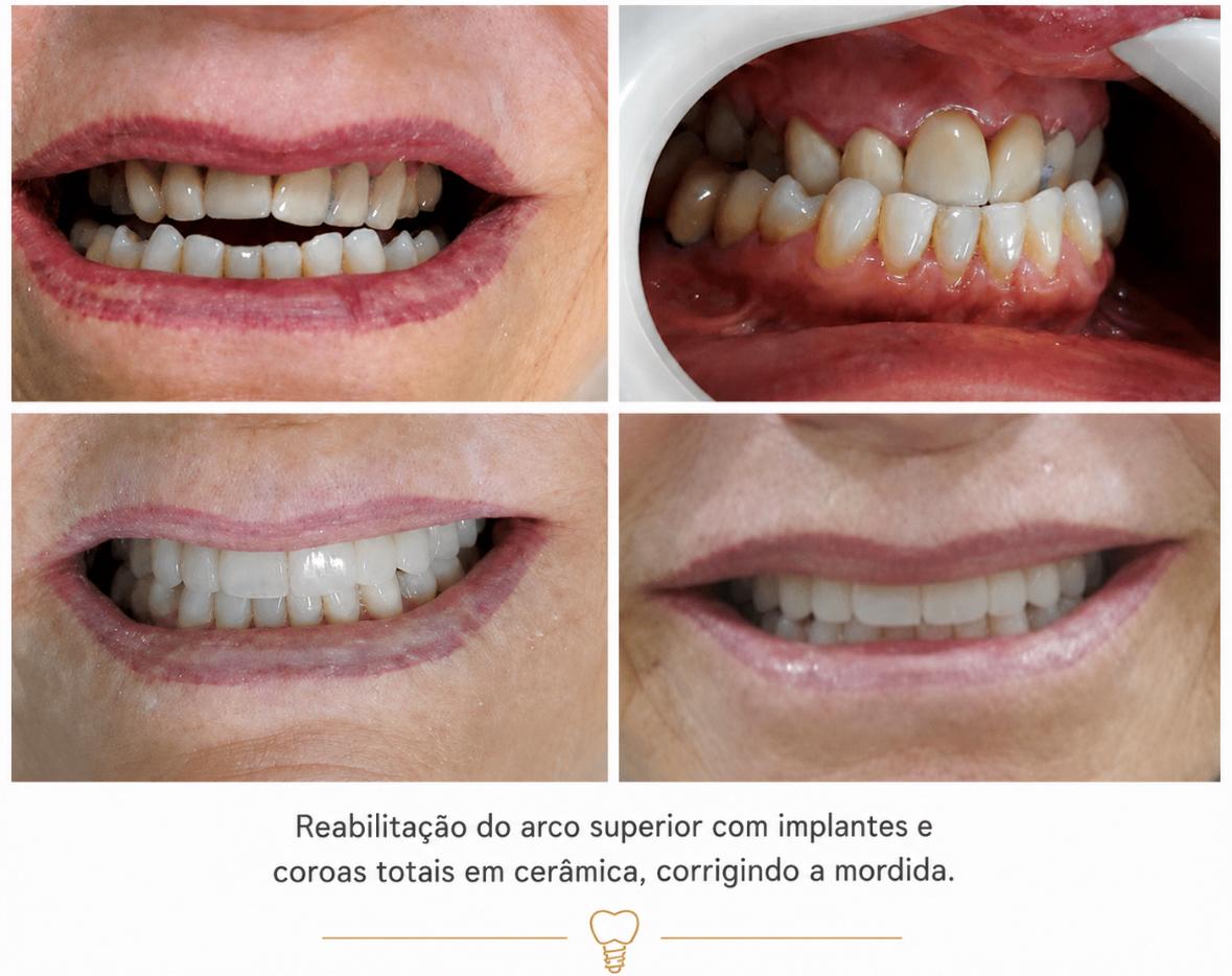 Reabilitação do arco superior com implantes e coroas totais em cerâmica, corrigindo a mordida.