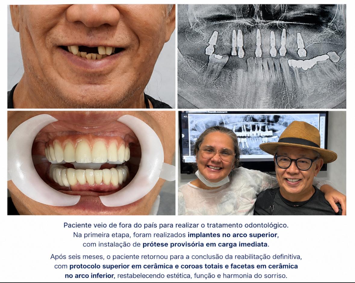 Paciente veio de fora do país: implantes no arco superior com prótese provisória em carga imediata e, após seis meses, protocolo superior em cerâmica e coroas e facetas no arco inferior.