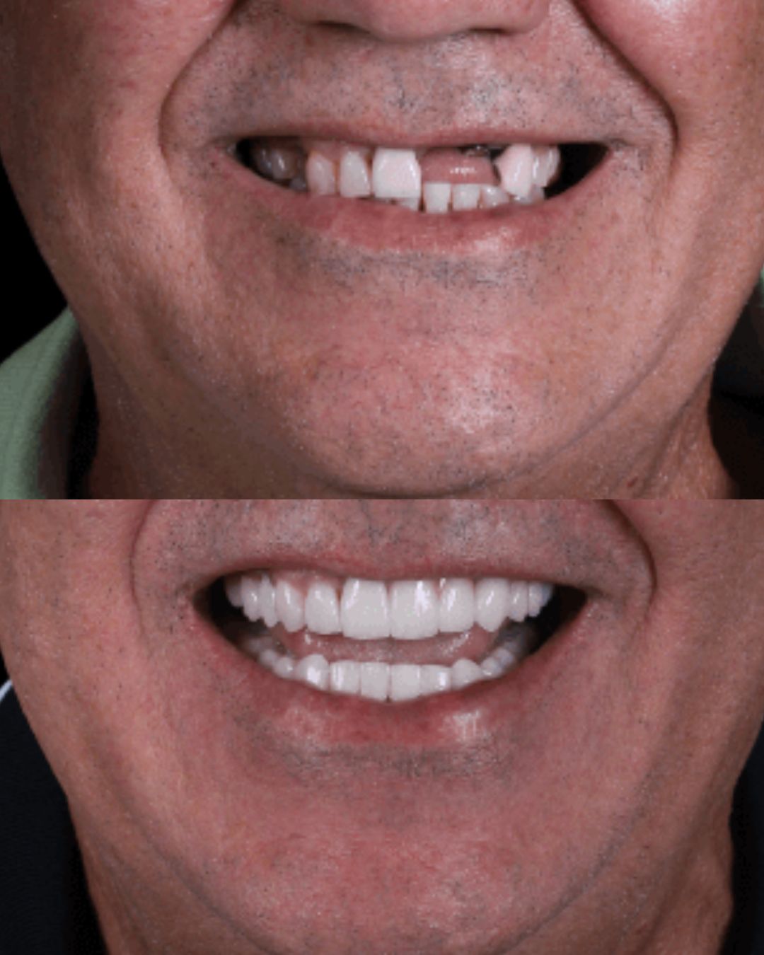 Antes e depois de um paciente da Nova Implante, sorriso reabilitado com implantes