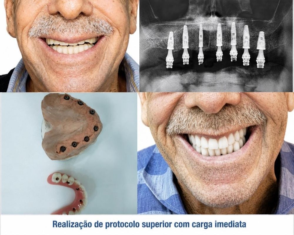 Realização de protocolo superior com carga imediata.